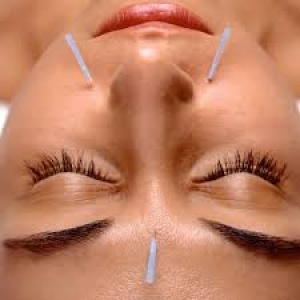 SEIRIN Acupuncture needle Type B